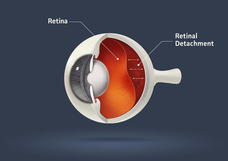 Signs-of-Retinal-Detachment.jpeg