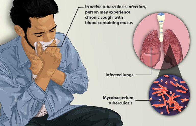 800px-Depiction_of_a_tuberculosis_patient.jpg