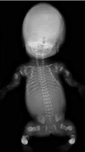 Image of Osteogenesis imperfecta type 2, baby with multiple fractures