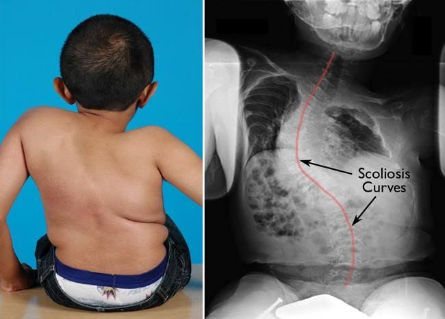 Image of Osteogenesis imperfecta type 4, adult with a slight curvature of the spine