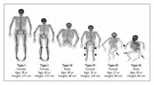 Image of Osteogenesis imperfecta type 3, child with bowed legs