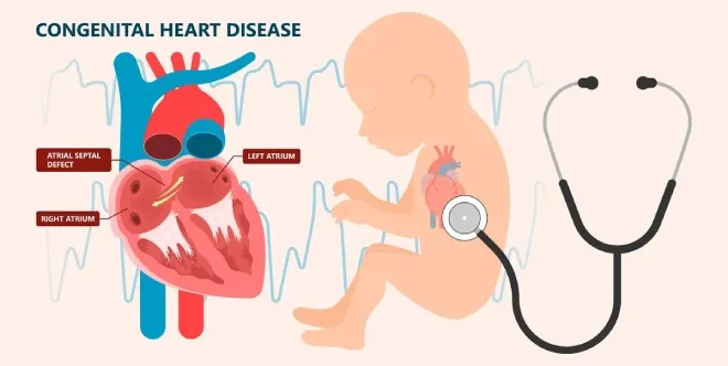 Congential-Heart-Disease.webp