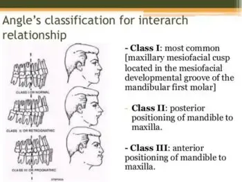 malocclusion-angle-faces-2-e1485793115727.webp