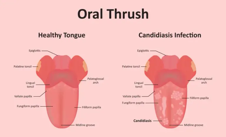 oral-thrush.webp