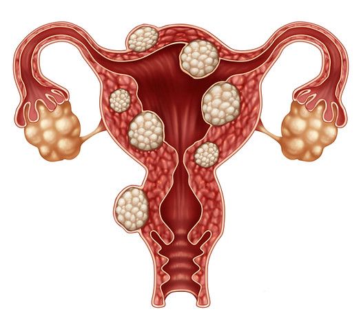 tp-uva-fibroids-cartoon.jpg