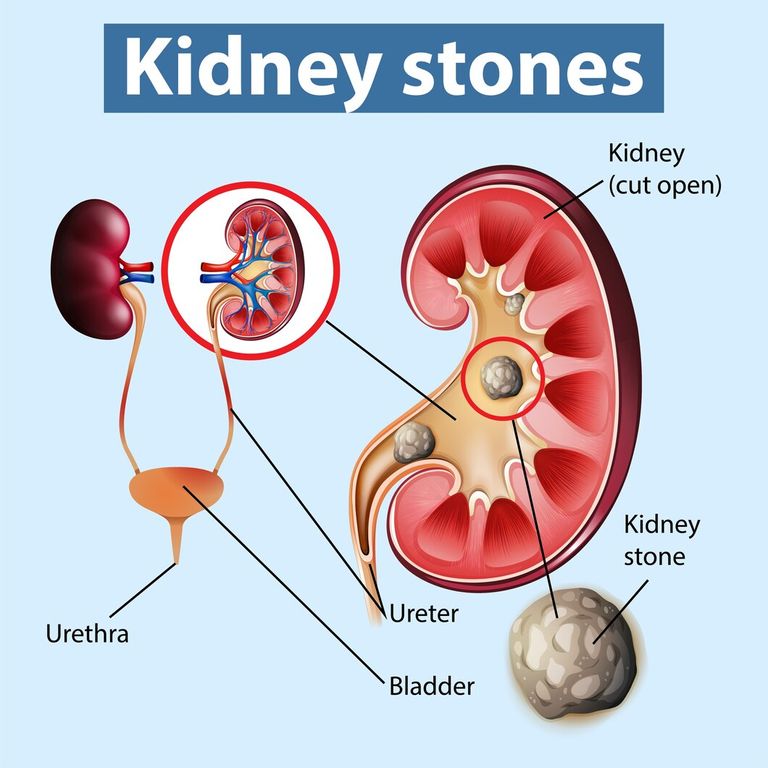 informative-illustration-kidney-stones_1308-50369.jpg