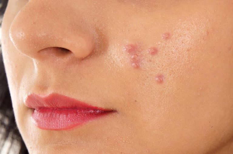 पिम्पल्स-हटाने-के-तरीके-घरेलू-उपाय-और-नुस्खे-Pimples-Kil-Muhase-ke-Gharelu-Upay-in-Hindi_.jpg