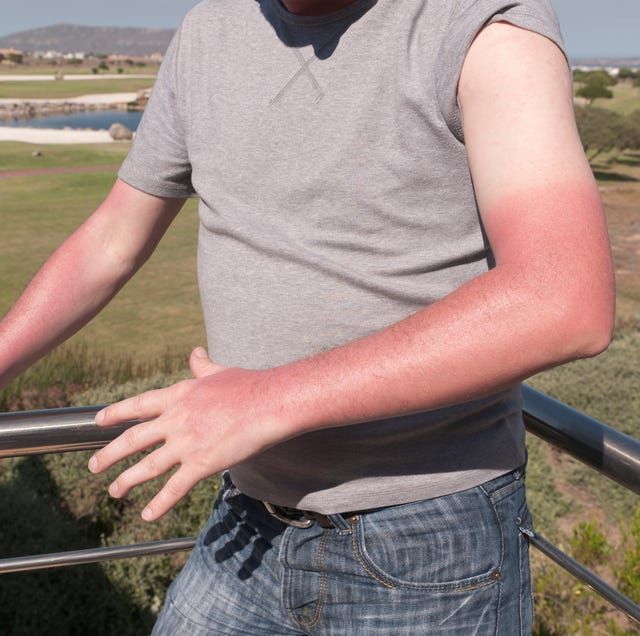 sunburn-royalty-free-image-1629225963.jpg