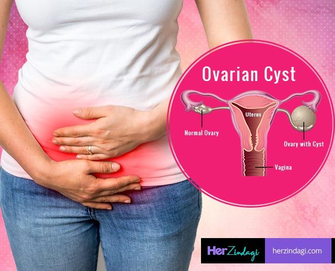 ovarian-cyst-megha-mamgain.jpg